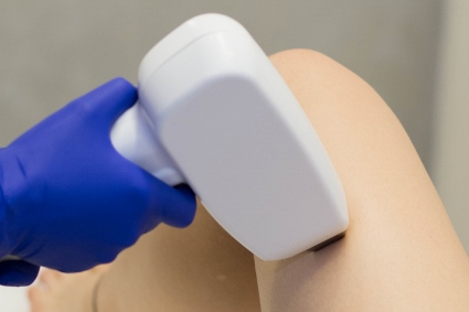 Jakie zalety ma depilacja laserowa?